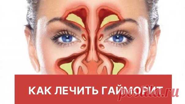 Как лечить гайморит Народным способом...

Взять 100 грамм мёда и растопить его на водяной бане.
Салфетку или марлю в 3 слоя смочить в этом мёде, но очень тёплом, даже горячем, чтоб только можно было терпеть и наложить на носовые пазухи и лоб.
Всё это проделывать естественно лёжа.
Когда чуть остынет — снова подогреваем мёд и снова туда салфетку и опять на лоб и пазухи.
И так 3 раза, пусть хорошенько прогреет.
Затем умыться тёплой водой, закапать в каждую ноздрю по 2-3 капли...