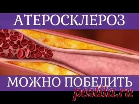 ❤ Как победить атеросклероз