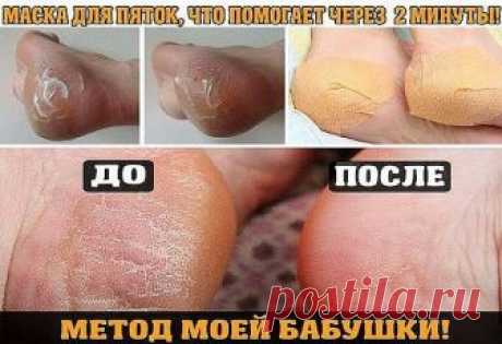 МАСКА ДЛЯ ПЯТОК, ЧТО ПОМОГАЕТ ЧЕРЕЗ 2 МИНУТЫ!

МЕТОД МОЕЙ БАБУШКИ!

Гладкие, шелковистые пяточки в любое время года — мечта женщины. Шершавые пятки превратить в идеал, можно благодаря нашим стараниям.


Ниже вас ждет народный, действенный рецепт избавления от твердых и шершавых пяток (проверенный на собственном опыте)... 

Компресс из репчатого лука 




Этот компресс делается перед сном и оставляется на всю ночь. 

Процедуру повторить до пяти раз. 

1. Луковицу мелко поре...