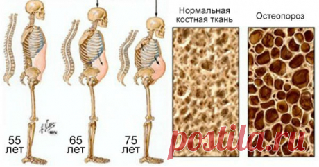 Этот напиток разрушает кости изнутри