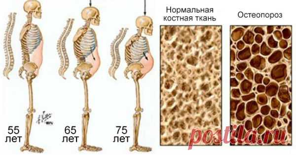 Этот напиток разрушает кости изнутри