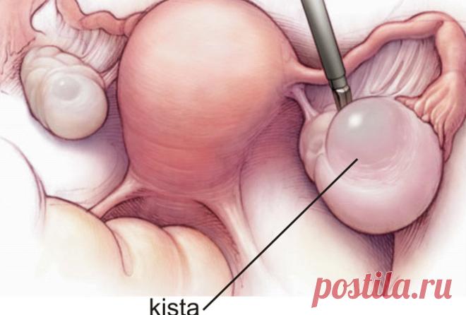 Я только ПИЛА этот напиток и моя киста исчезла за 5 дней! Смотрите самые эффективные рецепты! Этому заболеванию подвержены тысячи женщин со всего мира! Народные рецепты помогают успешно избавиться от него!   Большинство пациентов — молодые женщины и женщи�…