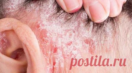 Сіздің басыңызға папьязаны құтылу қажет пе? ХАБАРЛАМА: Оның ізгі күні, басқа да оқырмандары басым болды! Бүгінде сіз бастың терісінің шығуын білесіз: симптомдары, себептері, сондай-ақ емдеу әдістері туралы. Бұл инфекцияның созылмалы инфузиясының ең ыңғайлы түрі. Бұл адам үшін қауіпті, бірақ ешқашан ешкім пайдаланбайтын, бірақ рухани тако арқылы қиындықтар емес.