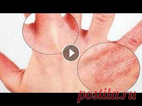 Если антисептик и мыло сушат кожу рук. Сухая кожа рук. У многих после частого мыться рук или/и применения антисептика кожа рук не просто пересыхает, а трескается и болит. Несколько советов, которые помогут...