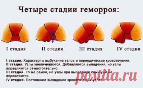 Симптомы геморроя, описание болезни, развитие геморроя