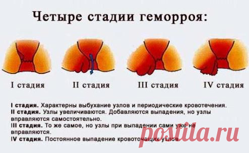 Симптомы геморроя, описание болезни, развитие геморроя