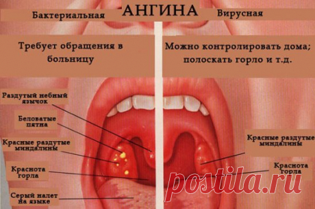 Лечение ангины и воспалений горла без антибиотиков 
А можно ли вылечить ангину без антибиотиков? Такой вопрос у меня впервые возник опять же во время беременности. Огромное спасибо нашим детям: они еще даже не успев родиться, заставляют нас задуматься о том, о чем бы мы сами никогда и не задумались. С тех пор антибиотики для лечения ангины мы не употребляем, да и ангина стала редким гостем. То ли неинтересно ей у нас, то ли мы успеваем вылечиться, так толком и не разболевшись. 
Я перечислю некот
