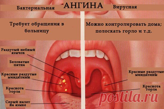 Лечение ангины и воспалений горла без антибиотиков 
А можно ли вылечить ангину без антибиотиков? Такой вопрос у меня впервые возник опять же во время беременности. Огромное спасибо нашим детям: они еще даже не успев родиться, заставляют нас задуматься о том, о чем бы мы сами никогда и не задумались. С тех пор антибиотики для лечения ангины мы не употребляем, да и ангина стала редким гостем. То ли неинтересно ей у нас, то ли мы успеваем вылечиться, так толком и не разболевшись. 
Я перечислю некот