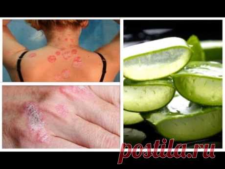 Это удивительное растение может бороться с псориазом, экземой, дерматитом и другими -заболеваниями кожи Очень полезно!