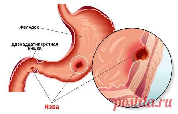 Как предотвратить и облегчить симптомы язвы желудка