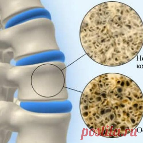 Причины симптомы и профилактика остеопороза