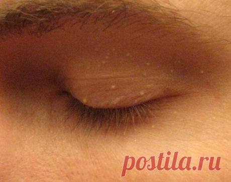 Милиумы: что это такое и как с ними бороться