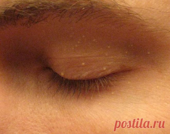 Милиумы: что это такое и как с ними бороться