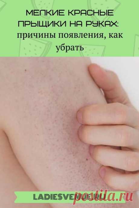 Мелкие красные прыщики на руках: что это, как убрать - Ladiesvenue.ru Эту проблему еще называют КУРИНАЯ КОЖА — мелкие красные прыщики на руках — и всех, у кого имеются такие россыпи хотят знать — что это и как от них избавиться? Сыпь, которая выглядит как десятки крошечных красных прыщиков, расположенных близко друг к другу — проблема частая. Научно она называется кератоз пиларис — но не волнуйтесь, …