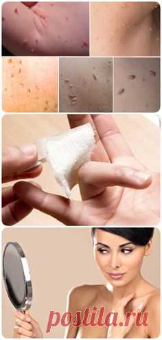 5 лучших домашних средств для удаления папиллом! Безопасно и без шрамов!