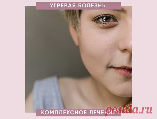 Разобраться с причиной возникновения и провести специальное лечение с индивидуальным подборов методов и средств может только врач дерматолог. Во время активного воспалительного процесса при угревой болезни очень важно предотвратить появление рубцов, которые образуются при выдавливании пустулы (гнойничка).
Поэтому одно из основных правил поведения с высыпаниями — ничего не выдавливать самостоятельно, в противном случае можно усилить воспалительный процесс