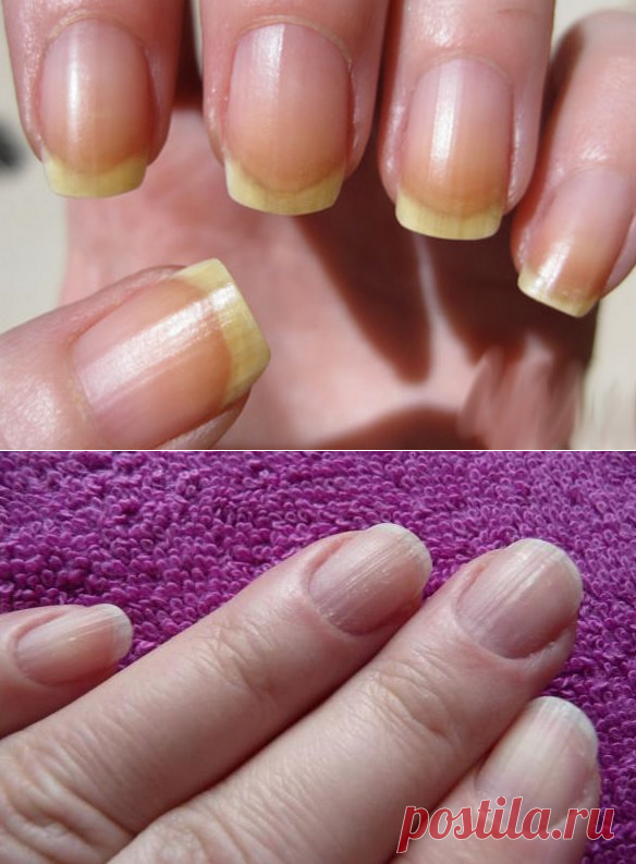 Взгляните на руки! 7 важных вещей, которые ногти говорят о вашем здоровье