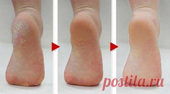 Очень хороший рецепт поможет тем, у кого шершавые руки, трещины на пятках.
Сохрани себе  и блистай пяточками
Берем глицерин. В первом случае можно с уксусом, во втором с нашатырным спиртом.
Аптечный пузырек с глицерином наполнен не до конца, вот и долейте в него уксус, встряхните.
А если с нашатырным спиртом, то смешиваются в пропорции 1:1 (глицерин и спирт).
Втирать этой смесью можно как утром, так и вечером, на ночь пятки, подошвы, пальцы и через несколько дней увидите потрясающий результат