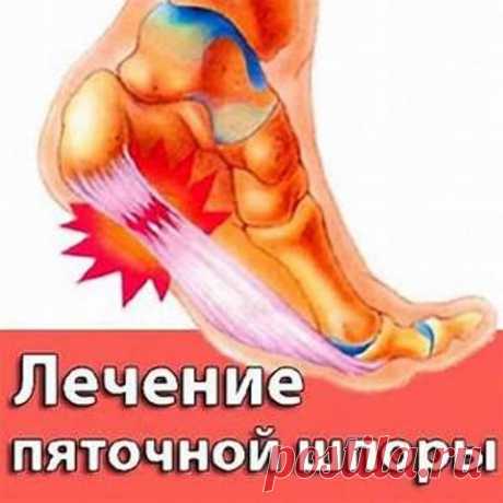 Лечение Пяточной Шпоры Народными Средствами!!!