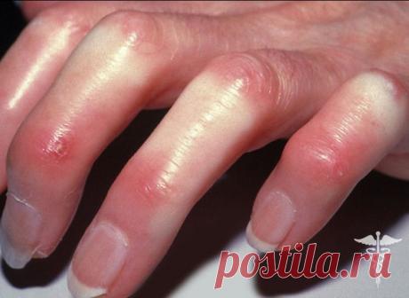 Склеродермия. Симптомы и лечение склеродермии