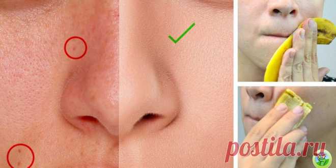 5 удивительных способов использования банановых пилингов для вашей кожи - Упражнения и похудение Невероятный эффект! Люди едят банан перед сном, если у них проблемы со сном. Но знаете ли вы, что вы можете использовать его для кожи? 5 различных способов использования банановой кожуры 1. Освобождает от симптомов экземы, прыщей и псориаза Банановая кожура может снизить зуд и воспаление, которое сопровождает серьезные состояния кожи, такие как псориаз, угри и экзема. …