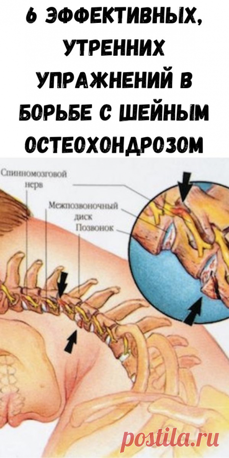 6 Эффективных, утренних Упражнений в борьбе с Шейным ОСТЕОХОНДРОЗОМ - Стильные советы