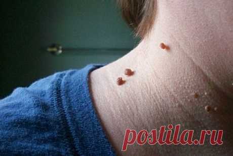 Легкий и безболезненный способ избавиться от папиллом! Это абсолютно не страшно! — Домашние заботы