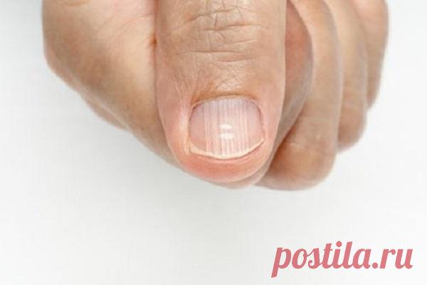Полоски на ногтях: откуда они и как предотвратить их появление? — Домашние заботы
