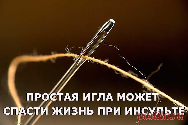 Простая игла может спасти жизнь при инсульте! — Домашний уют