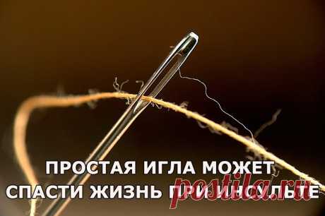 Простая игла может спасти жизнь при инсульте! — Домашний уют