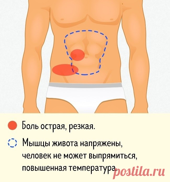 Аппендицит низ. Локализация боли в животе. Болит вся область живота. Рези возле пупка. Болит справа посередине живота.