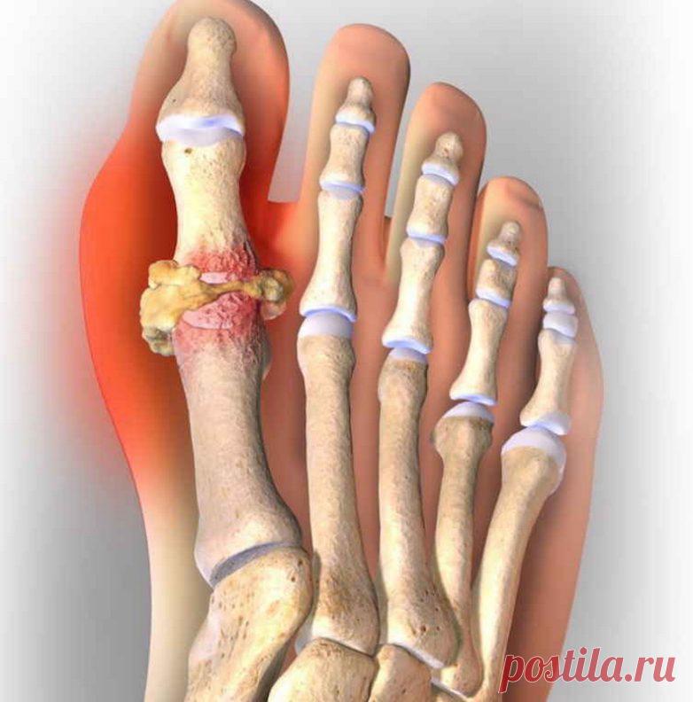 Что можно и чего нельзя есть. Подагра / Будьте здоровы