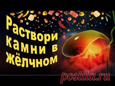 Как избавиться от камней в желчном пузыре без операции?