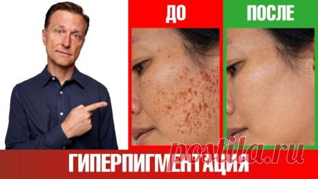 Защита кожи от пигментации: простые и эффективные меры