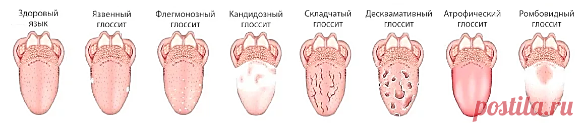 Стоматит на языке у взрослых, лечение стоматита на языке, эффективные ...