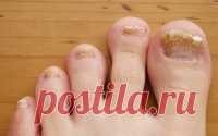Как избавиться от грибка ногтей на ногах Грибок ногтей является очень распространенным заболеванием, как у мужчин, так и у женщин. Многие не спешат с таким заболеванием обращаться к врачу, да и