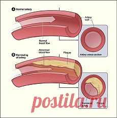 Холестерин мифы и реальность