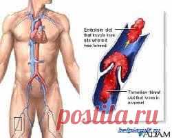 Средства для разжижения крови |