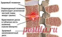 Грыжа Шморля: симптомы, местоположение, виды, лечение
Здоровая спина — залог хорошего самочувствия в любом возрасте. Болезненные ощущения могут быть как источником ощутимого дискомфорта, так сигналом серьезных заболеваний. Одно из вероятных — грыжа Шморля.