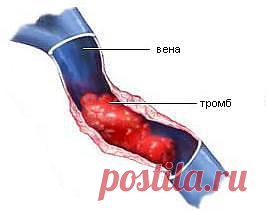 Тромбофлебит и природные лекари | Друг пенсионера
Хочу рассказать вам о такой болезни как тромбофлебит и способах борьбы с ней
