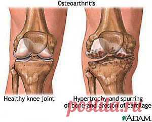 Артрит.Артроз.Как отличить? | Знахаръ