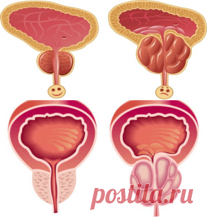 Аденома простаты - лечение народными средствами