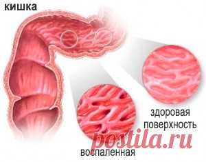 Все о катаральном колите кишечника. Симптомы, причины, лечение