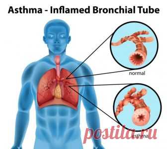 Бронхиальная астма: причины, симптомы, методы диагностики