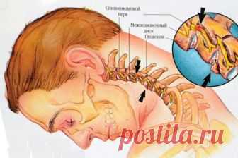 Простое избавление от остеохондроза: как муж вылечился - interesno.win