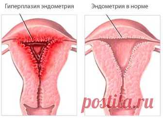 Гиперплазия эндометрия в климактерический период
Это самое опасное время, когда гиперплазия имеет высокие шансы перейти в онкологический процесс (около 50%). Поэтому после 40 лет женщина должна уделять особое внимание гинекологическим проблемам. Период перед климаксом и сам климакс связаны с огромной перестройкой в организме женщины, которая, к сожалению, не всегда проходит благополучно.

Очень часто (60%) гиперплазия сопровождается сильными маточными кровотечениями. Поэто...