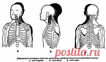 Мышечно-функциональный дисбаланс Академик Н.А. Бернштейн (1926) сравнил спину человека с конструкцией цепочной мачты: позвоночный столб – центральная ось, а мышцы вокруг позвоночника подобны растяжкам мачты …
