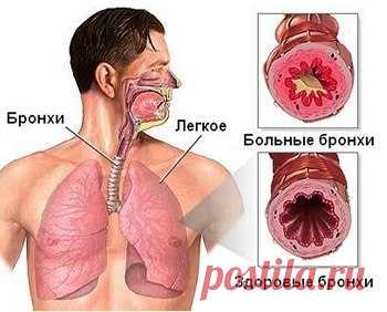 Народные средства лечения бронхита