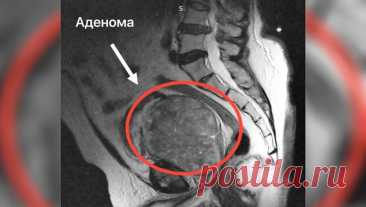 В Подмосковье врачи спасли пациента, простата которого была увеличена в 20 раз. Врачи Подмосковья прооперировали мужчину с увеличенной простатой. Об этом сообщает минздрав региона. Пенсионер обратился к медикам после того, как почувствовал боль. Помимо этого, он обратил внимание на проблемы с мочеиспусканием. В ...