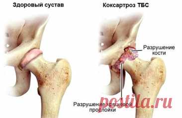 Гимнастика Евдокименко для тазобедренных суставов: лечение артрита и коксартроза с видео